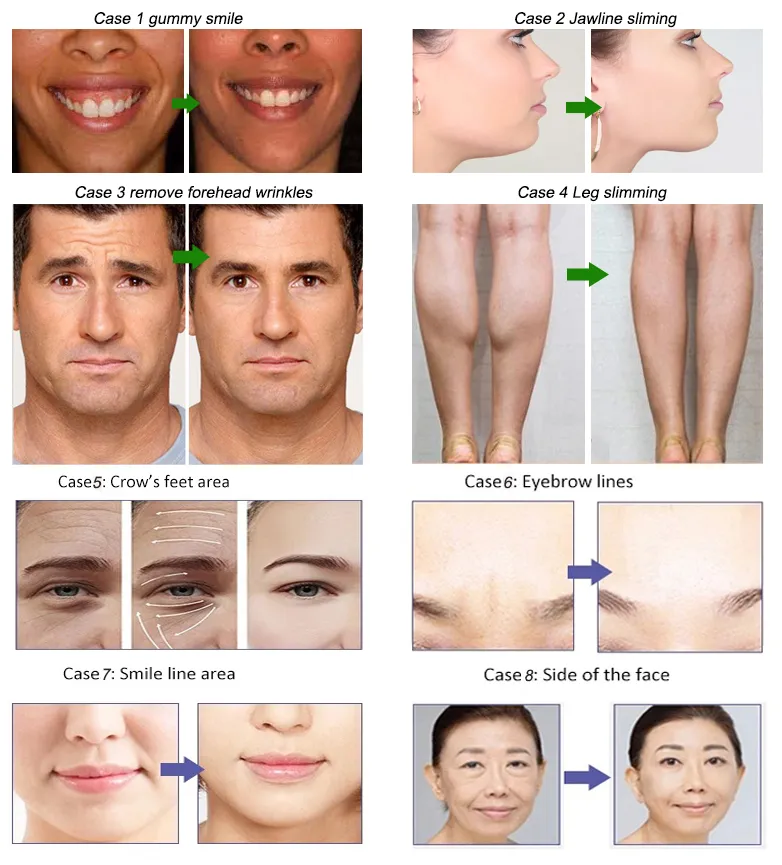 Slimming Anti Wrinkle Beutox Batulaxs Resty Dermal Filler Juvederms